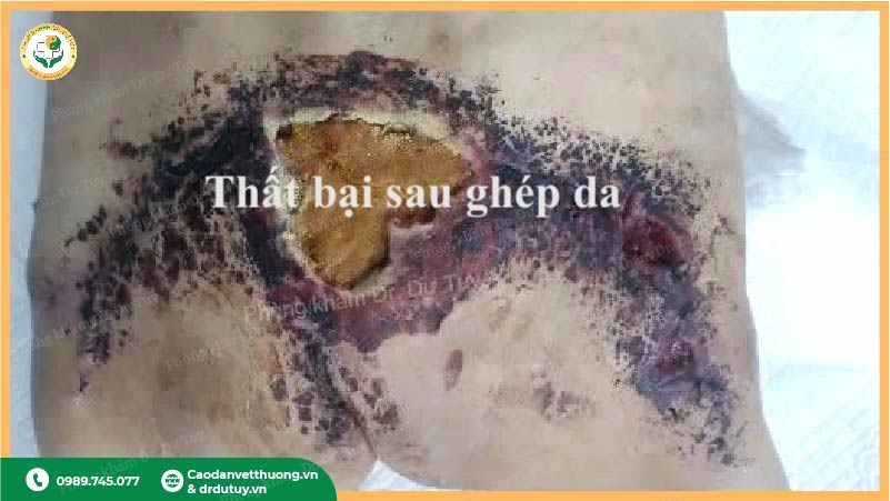 thất bại sau ghép da biến chứng hoại tử vết ghép