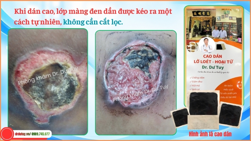 thay đổi mảng sẫm màu vết loét cùng cụt