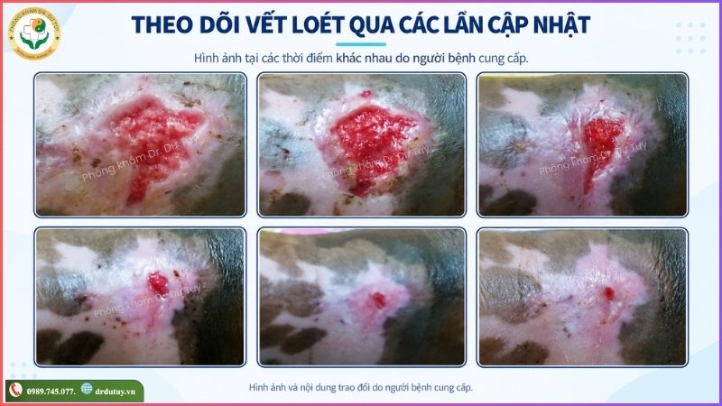 theo dõi vết loét qua các lần cập nhật