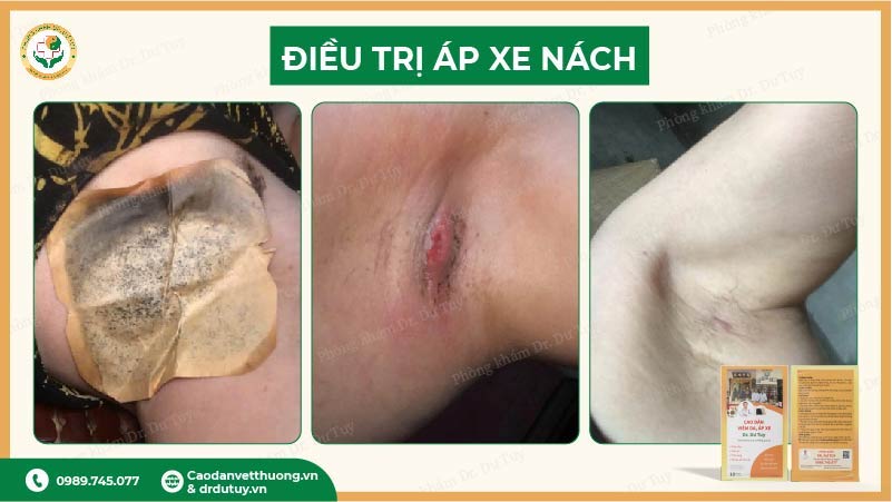 thời gian hồi phục áp xe nách