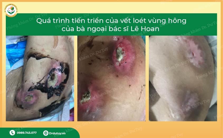 thuốc điều trị loét tỳ đè