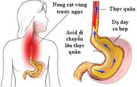 thuoc-dong-y-chua-benh-trao-nguoc-da-day