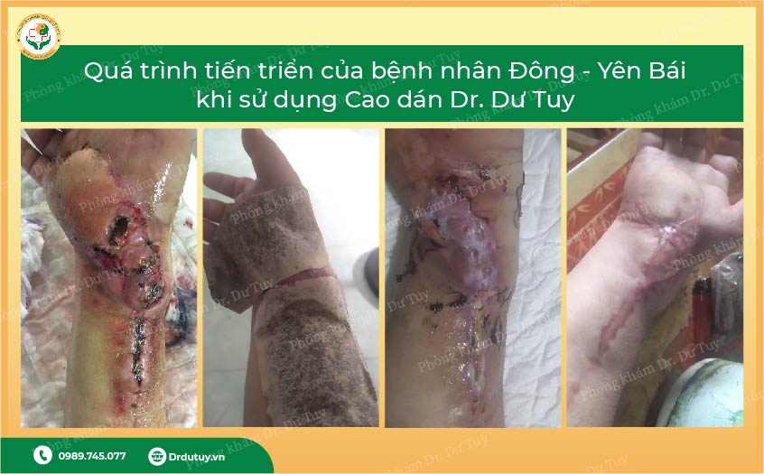 thuốc đông y trị viêm
