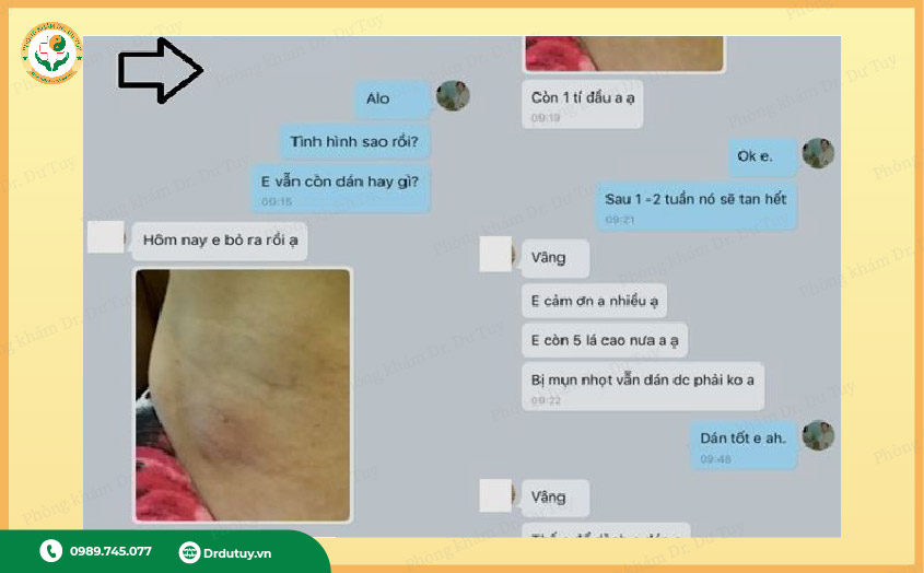thuốc trị áp xe nách