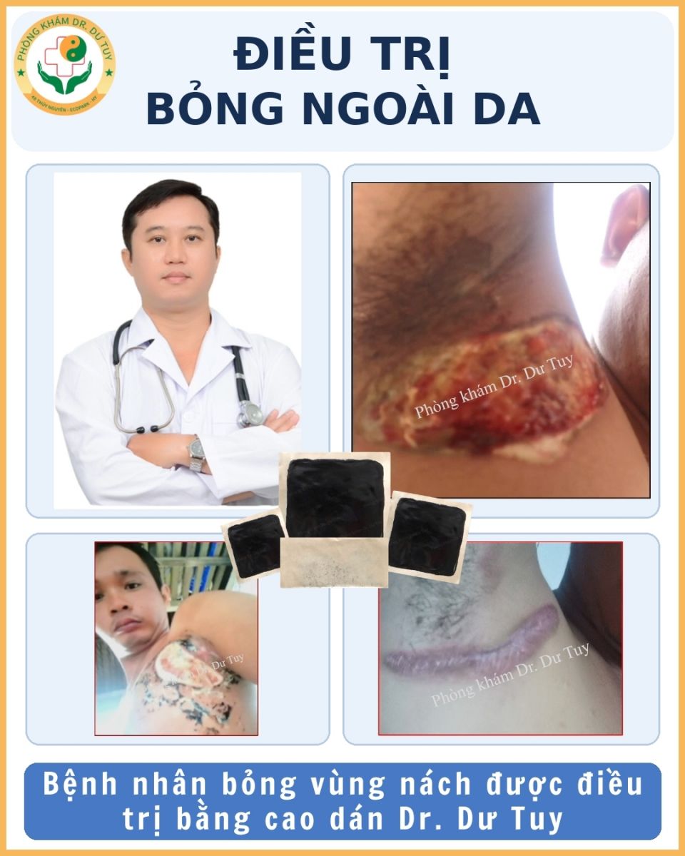 thuốc trị bỏng ngoài da