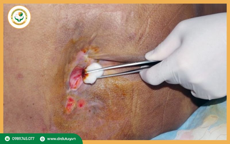 Thuốc trị hoại tử cho người già mau lành, nhanh khỏi