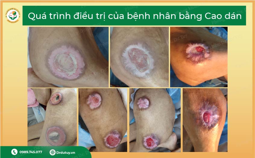 thuốc trị hoại tử vùng cùng cụt