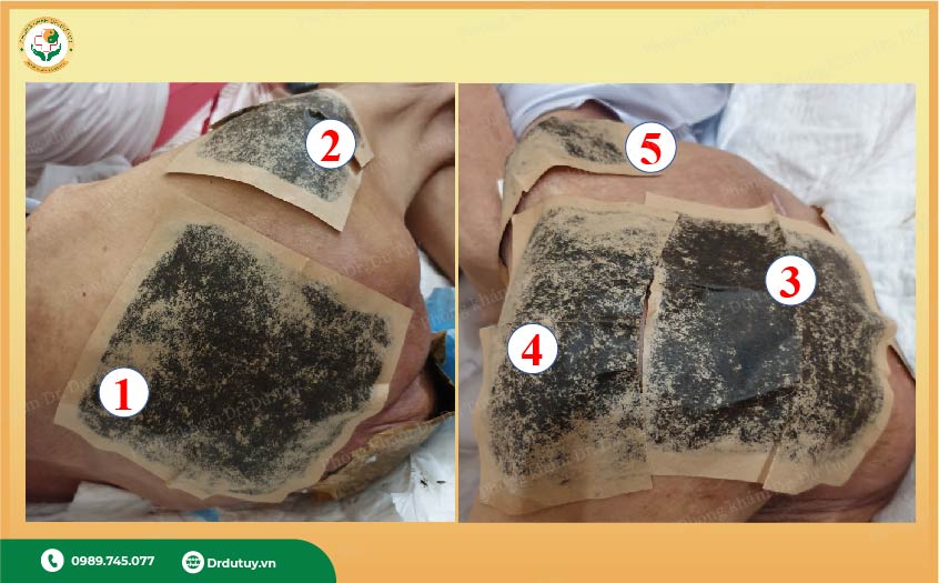 thuốc trị lở loét da