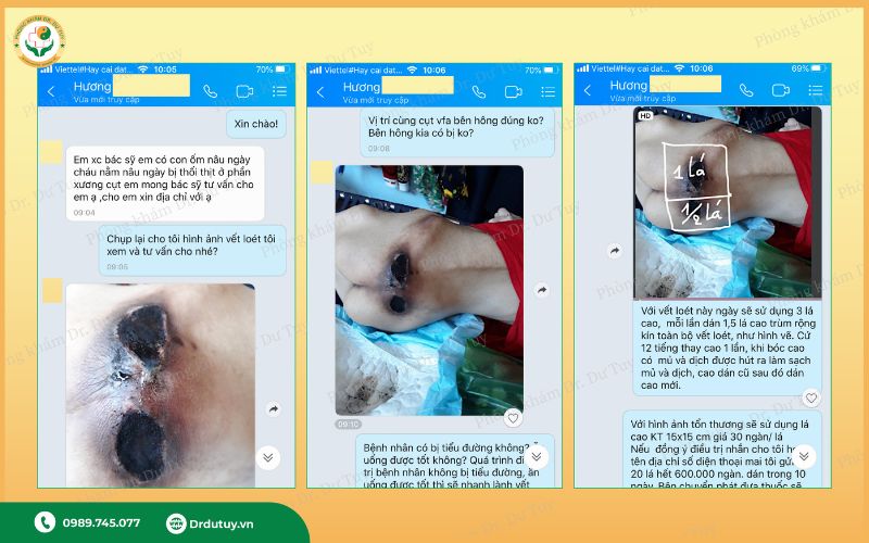 thuốc trị lở loét vùng cùng cụt
