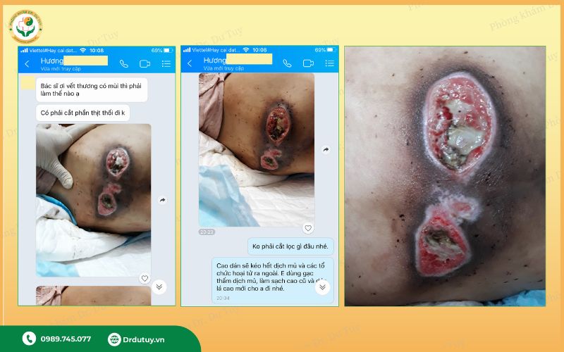 thuốc trị lở loét vùng cùng cụt