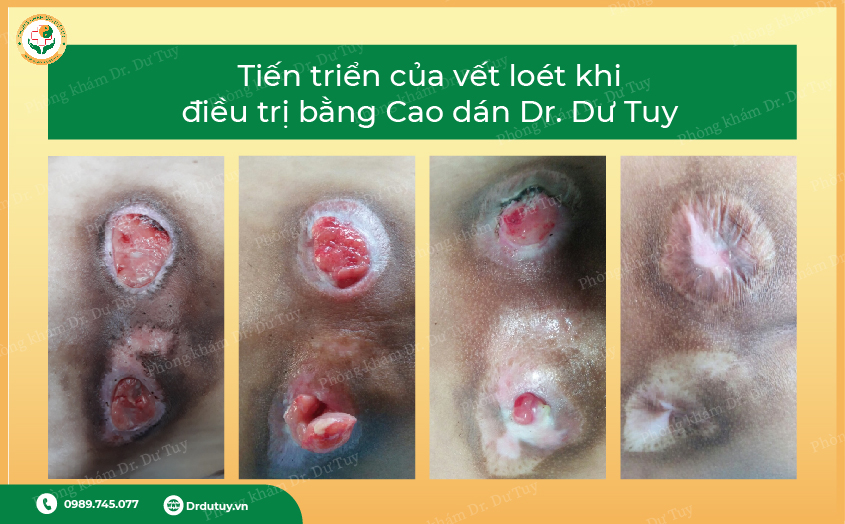 thuốc trị lở loét vùng cùng cụt