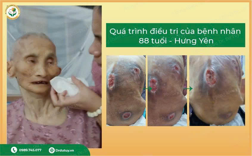 thuốc trị loét da không kháng sinh