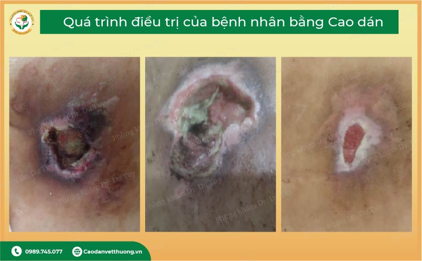 trị loét da vùng cùng cụt