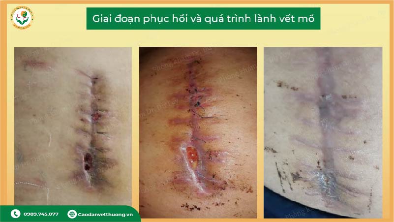 thuốc trị nhiễm trùng vết mổ