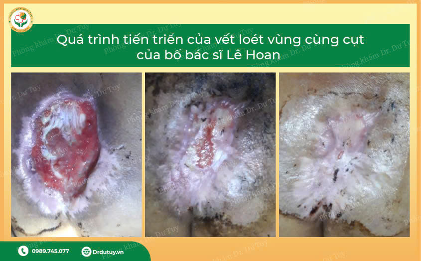 thuốc xịt chống loét cho người gia