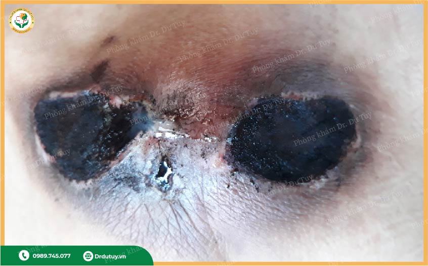 thuốc xịt chống loét