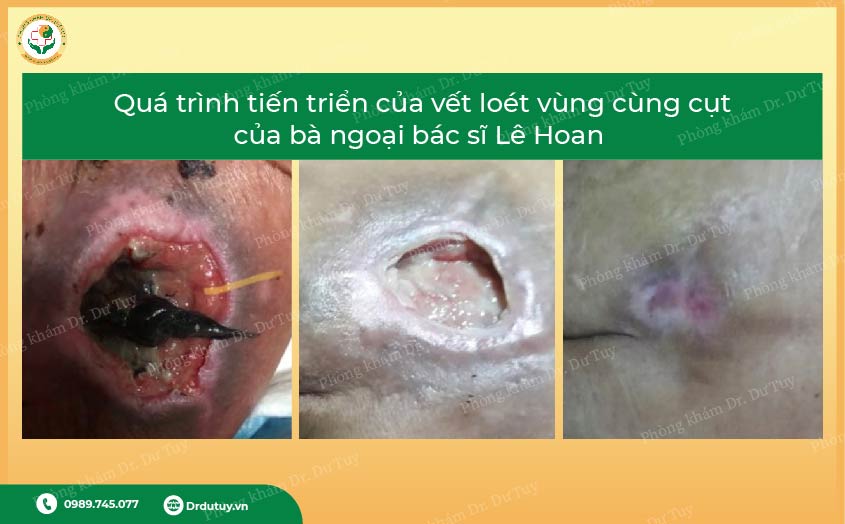 thuốc xịt chữa loét da