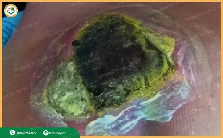 thuốc xịt tạo màng