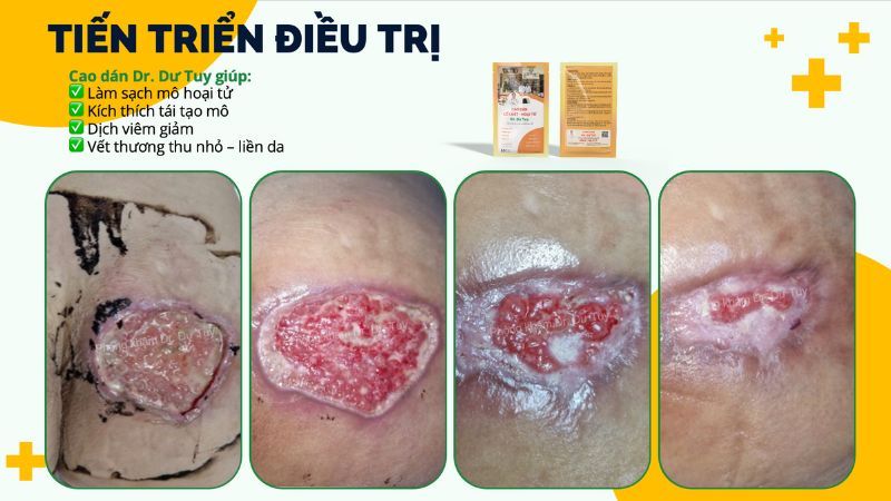 tiến triển điều trị biến chứng filler