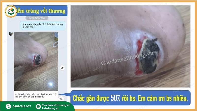 tiến triển điều trị vết thương gót chân