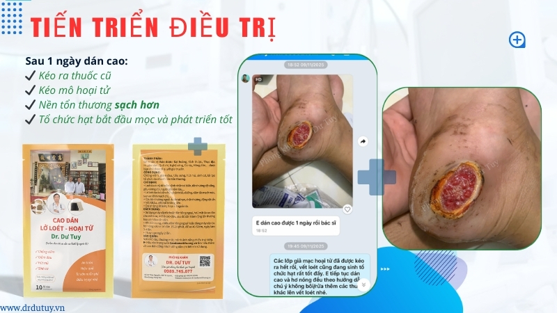 tiến triển lở loét gót chân sau 1 ngày