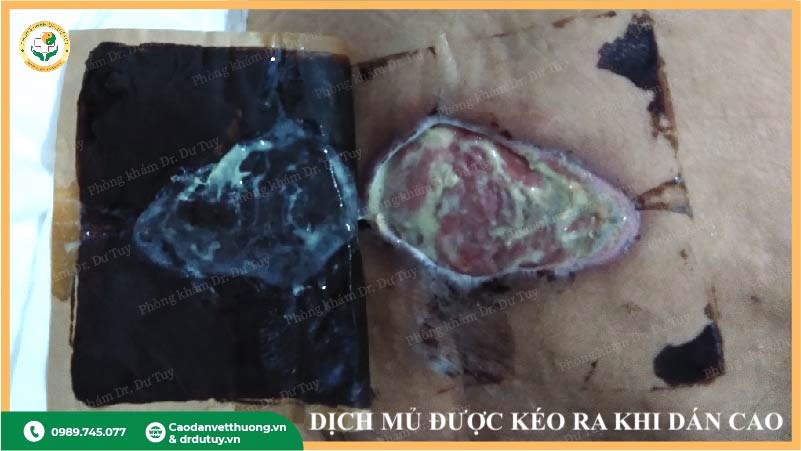 tiến triển lở loét sau kkhi dán cao thảo dược
