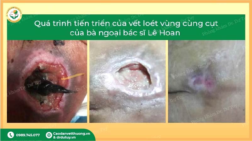 tiến triển lở loét vùng hông sau dán cao