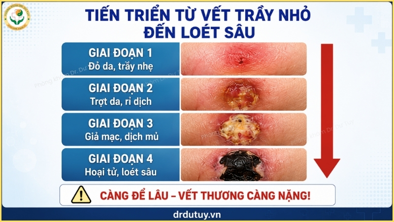 tiến triển vết trầy nhỏ vùng cùng cụt đến loét sâu