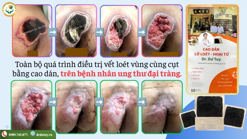 toàn bộ quá trình phục hồi vết loét cùng cụt