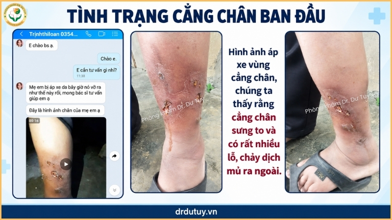 tổn thương cẳng chân ban đầu