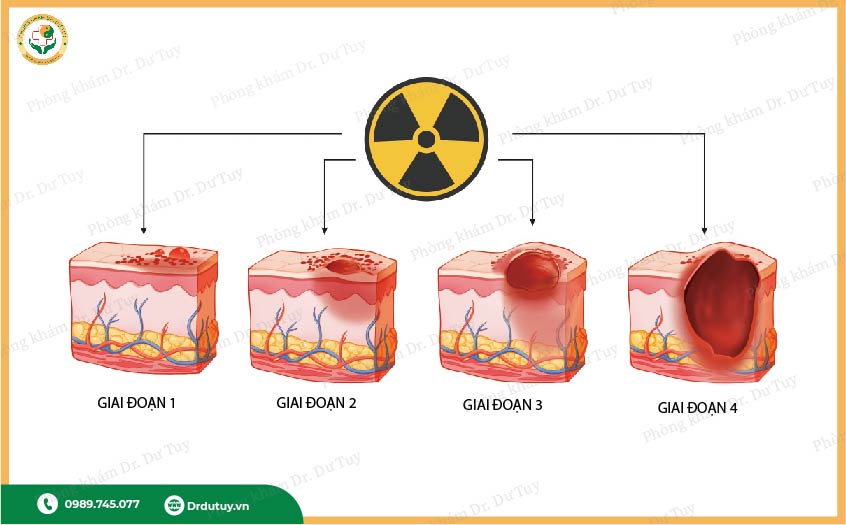 tổn thương da sau xạ trị