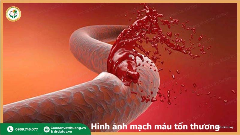 tổn thương mạch máu do tiểu đường