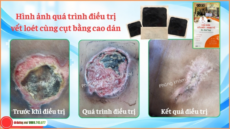 tổng hợp chăm sóc vết loét cùng cụt Dr. Dư Tuy
