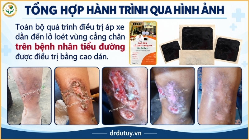 tổng hợp hành trình vết loét