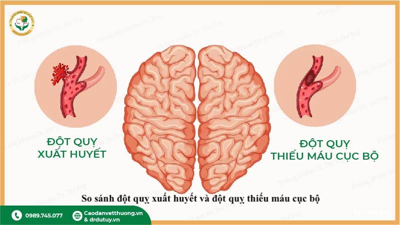 tổng quan đột quỵ não