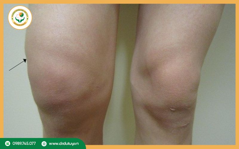 Tràn dịch khớp gối có chữa khỏi được không? Giải đáp chi tiết