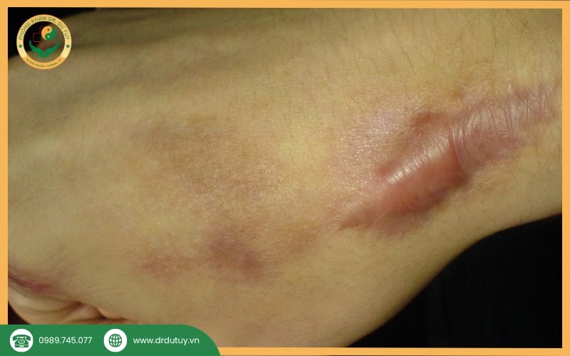 tránh để lại sẹo sau bỏng