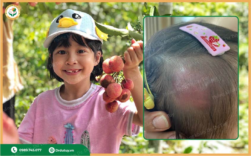 trẻ ăn nhiều hoa quả ngọt bị mụn nhọt