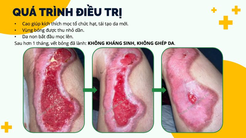 trị bỏng nặng tại nhà
