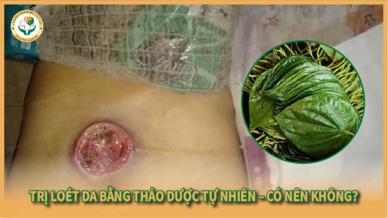Trị loét da bằng thảo dược tự nhiên – Có nên không?