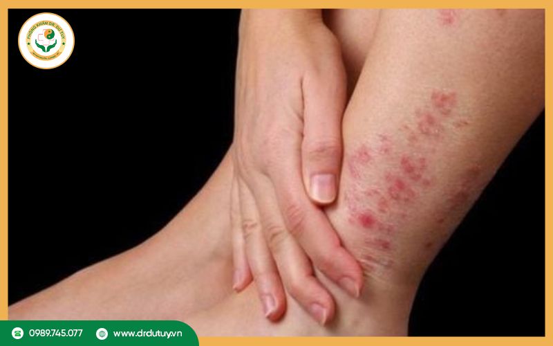 Lưu ý khi điều trị viêm da cơ địa tại nhà