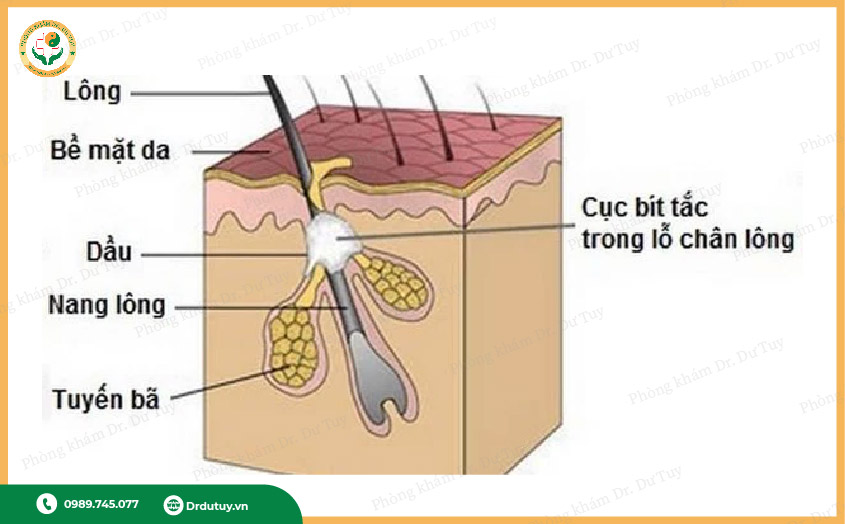triệu chứng áp xe nách