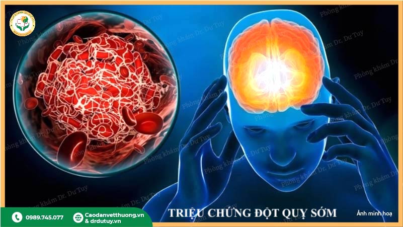 triệu chứng đột quỵ sớm