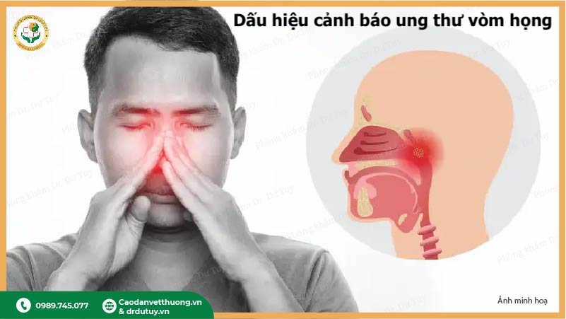 triệu chứng ung thư vòm họng sớm cần biết