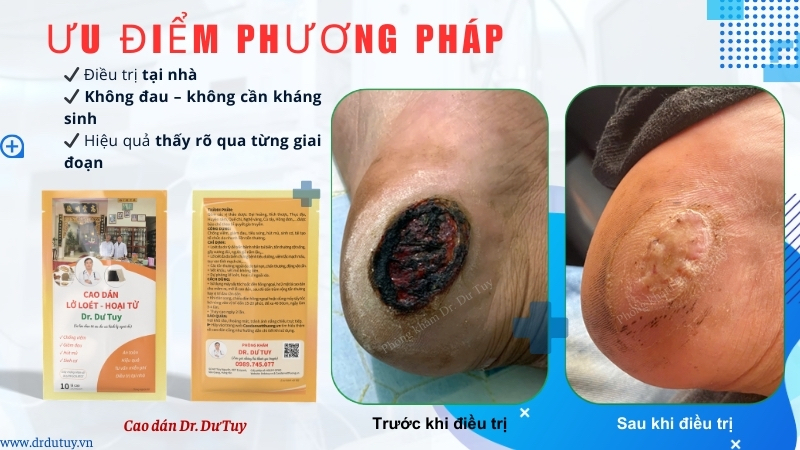 trước sau điều trị lở loét gót chân