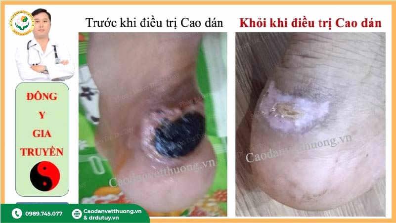 trước và sau điều trị vết thương gót chân