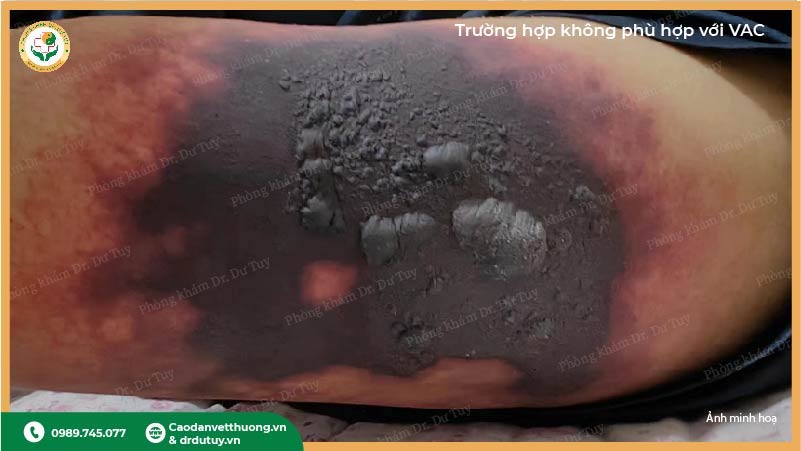 trường hợp không phù hợp điều trị VAC
