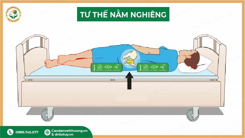 tư thế nằm nghiêng phòng loét tì đè