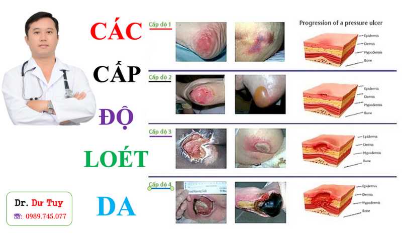 tu-van-dieu-tri-loet-da-duoi-su-huong-dan-cua-bac-sy-tuy