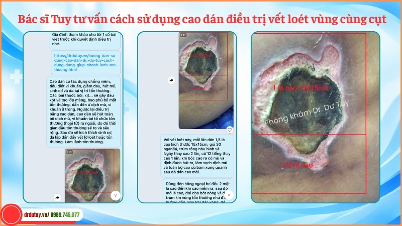 tư vấn sử dụng cao dán Dr Dư Tuy